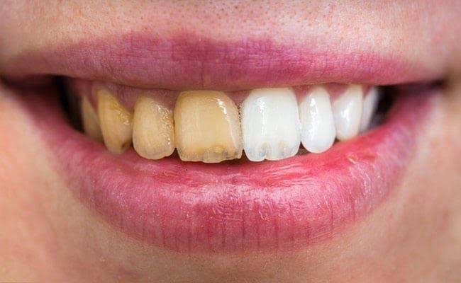 Get rid of yellow teeth by using these 4 tips